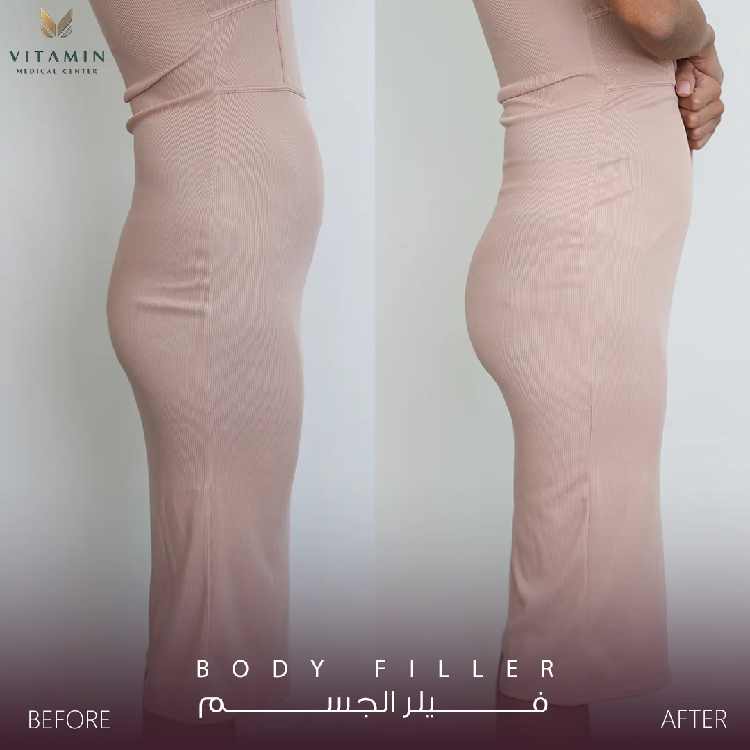 Before and after body filler, side view