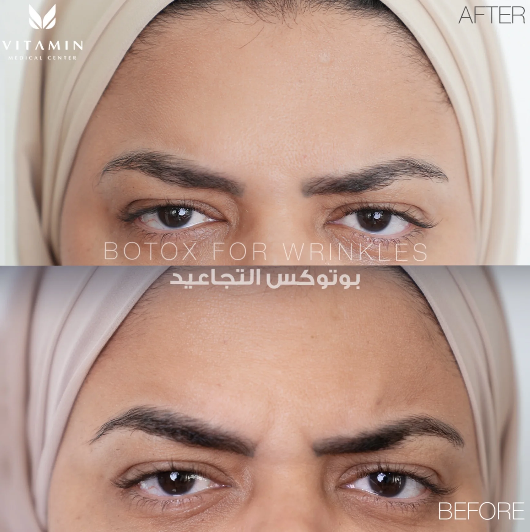 Before and after Botox treatment for frown lines between the eyebrows