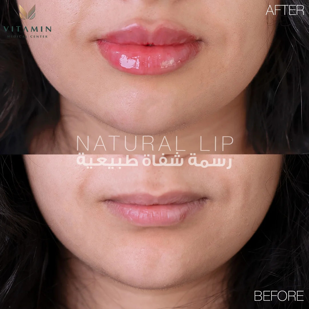 Before and after natural lip filler, front view