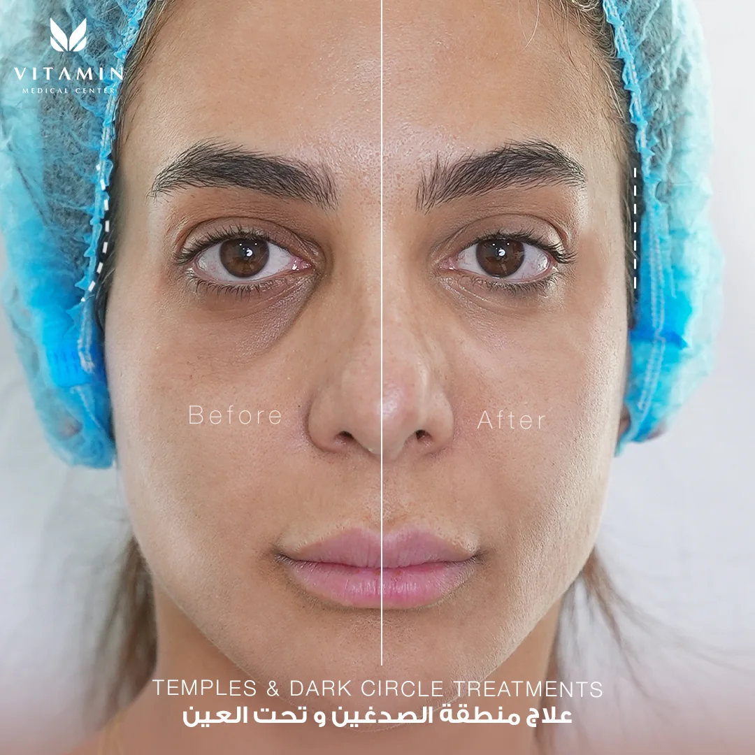 Before and after temples and under-eye treatment, second view