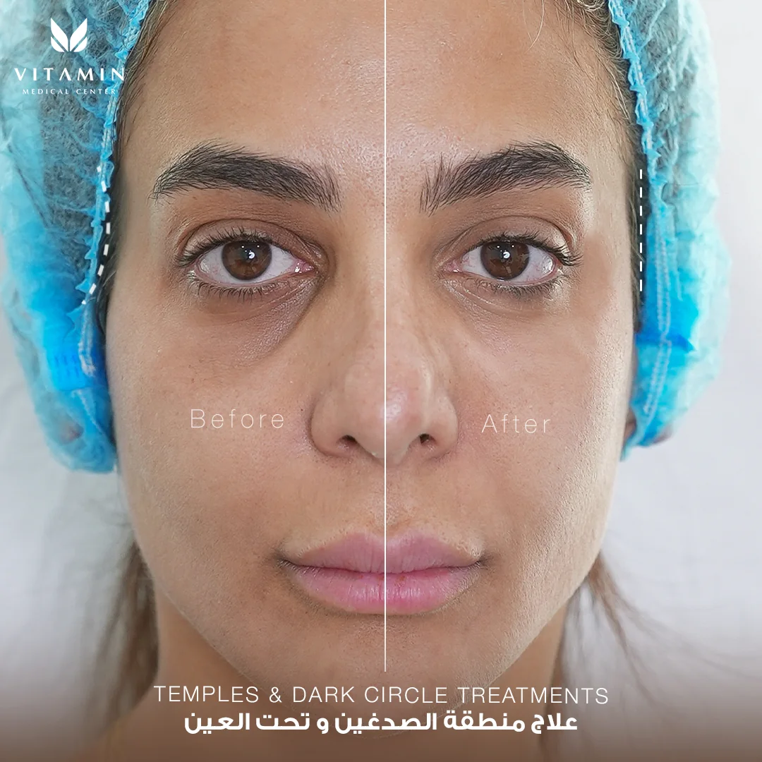 Split-face before and after of a temples and under-eye treatment