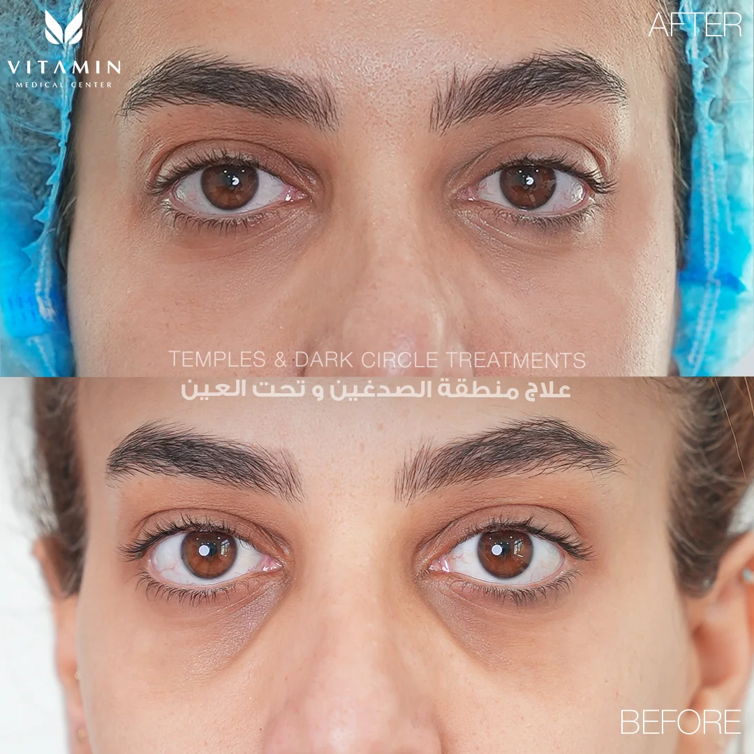 Before and after temples and dark circle treatment